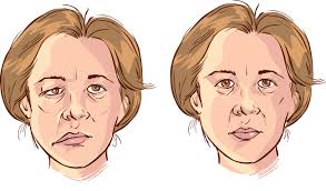 Parálisis facial