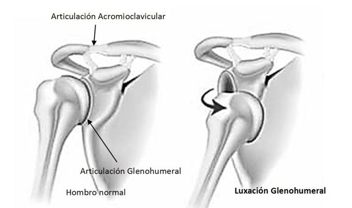 ¿Sabes lo que es la inestabilidad de hombro?