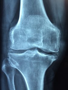 ¿Cuándo se necesita una prótesis de rodilla? ¿Cuándo se necesita una prótesis de rodilla?
