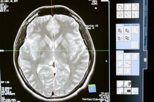 Ictus y fisioterapia: unidad inseparable